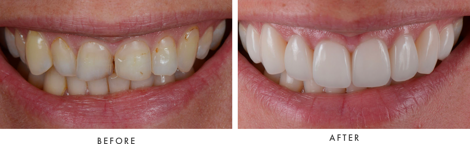 Porcelain Veneers