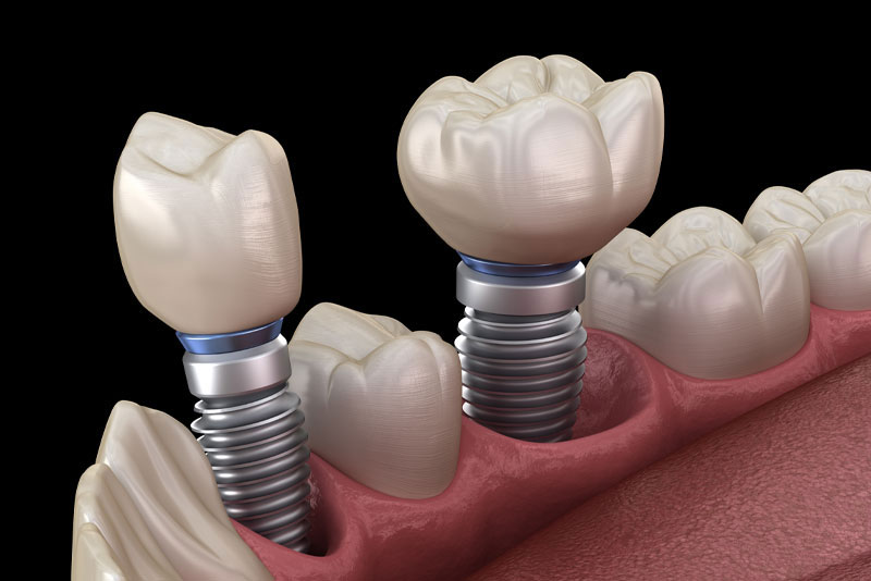 dental implants model 2