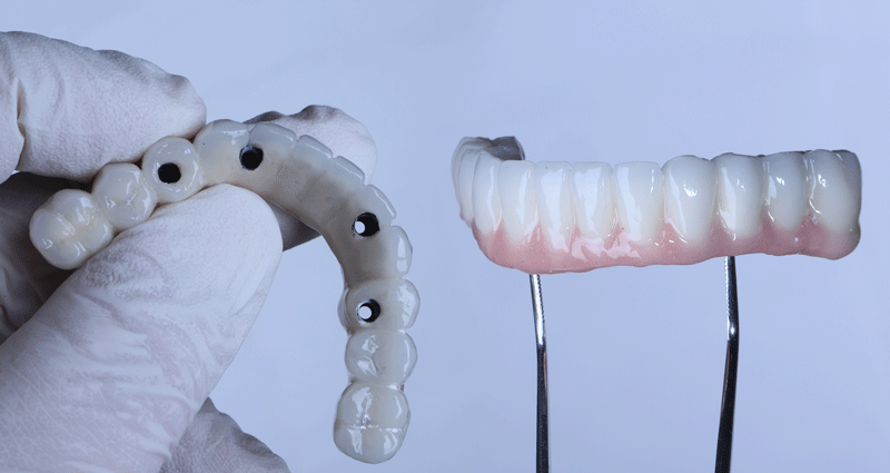 Unveiling the Four Types of Dental Implants: Which One’s for You?