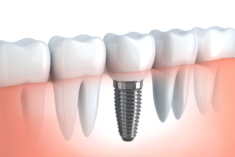 Navigating Dental Implant Risks: Essential Considerations and Safety Insights