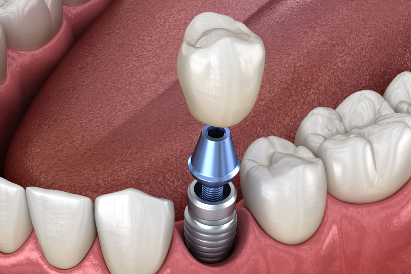 Understanding Your Abutment on Implant: A Comprehensive Guide to Dental Implants Success